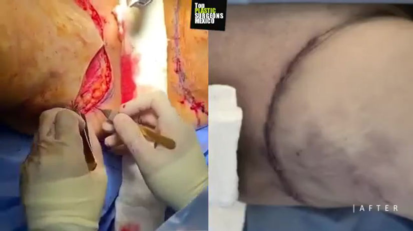 THIGHPLASTY (INCISIONS IN THE GROIN)